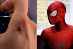 Un nio se deja picar por una viuda negra para ser Spider-Man y acaba hospitalizado