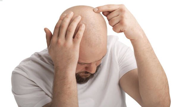 Adis a los injertos capilares en Turqua: descubren una protena que combate la calvicie