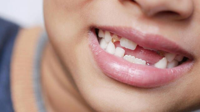 Cientficos descubren la forma de hacer crecer dientes en humanos como si fueran tiburones