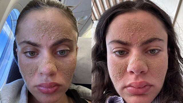 Los expertos en dermatologa advierten que la 'piel de caverncola' que arrasa en TikTok pone en riesgo la salud