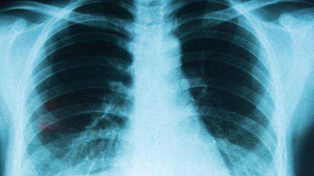La ciencia lo confirma: no hace falta fumar para desarrollar c�ncer de pulm�n y esto a lo que est�s expuesto lo provoca