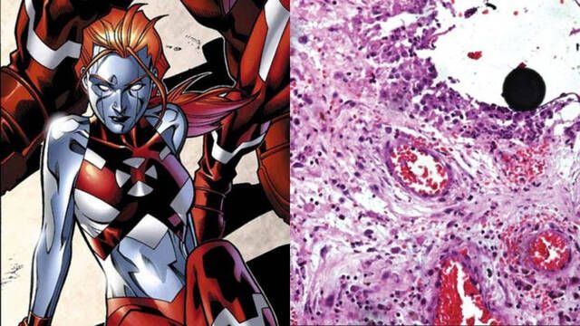 Joven de 15 a�os se inyecta mercurio para convertirse en un superh�roe de Marvel